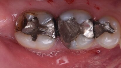 Immediate implant placement into two molar sockets