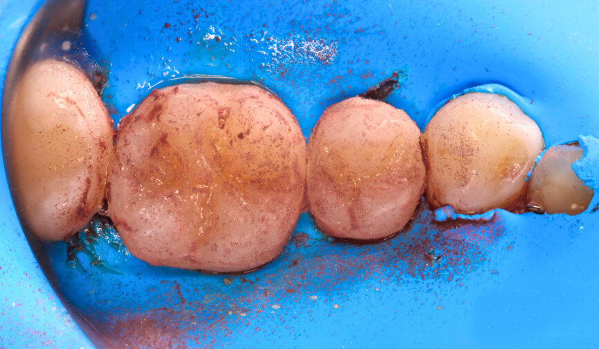 Fig. 3: During polishing without water cooling, fragments of the rubber remain on the composite surface. 