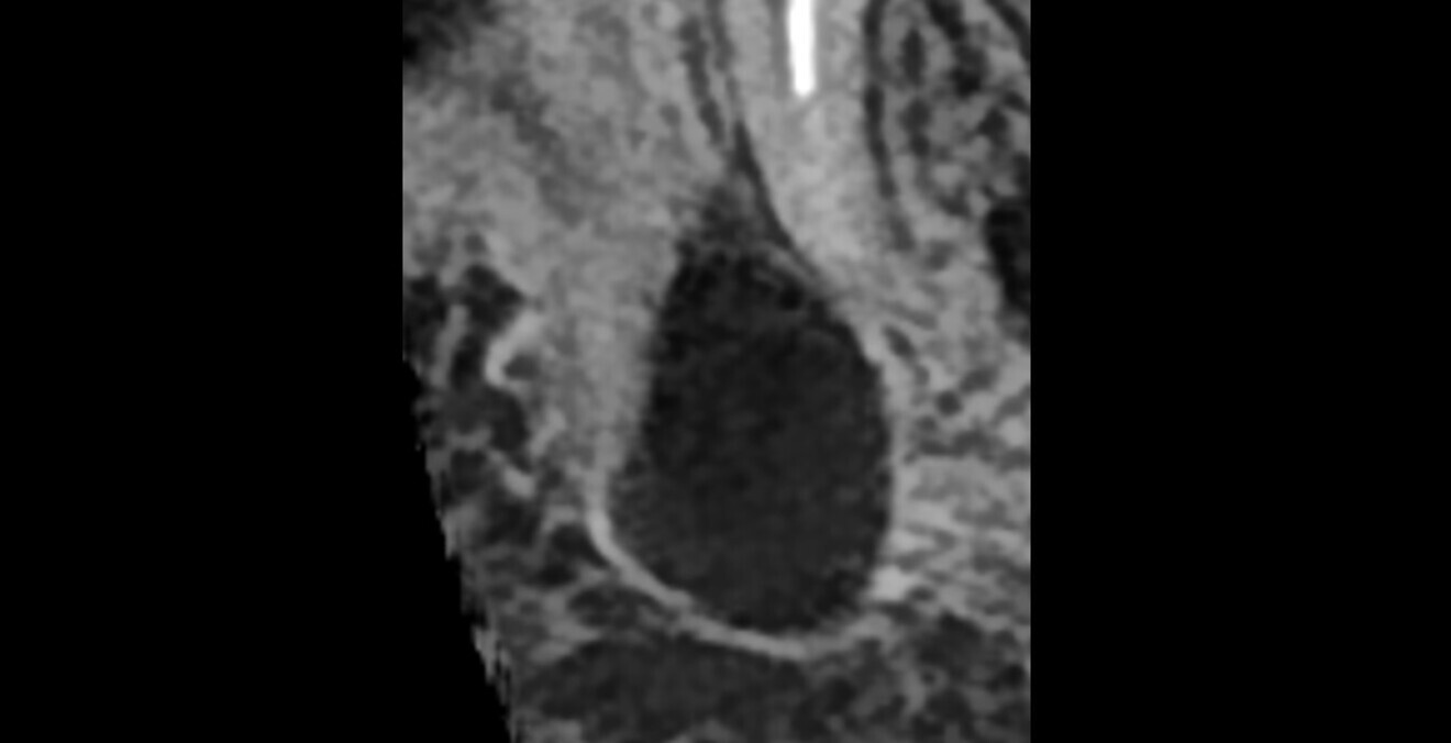 Fig. 3: Clear separation between the two lesions in the analysis of the 2D image generated from the DEXIS OP 3D scan in DTX Studio Clinic.
