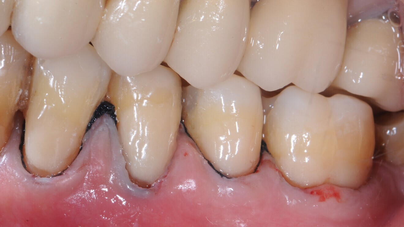 Fig. 2: Cervical lesions restored with the glass hybrid EQUIA Forte. 