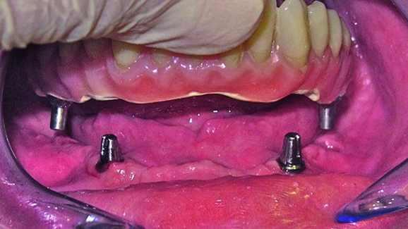 Prothèse totale fixe non métallique sur quatre implants SHORT®