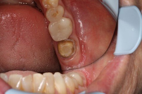 Initial situation, tooth 37
