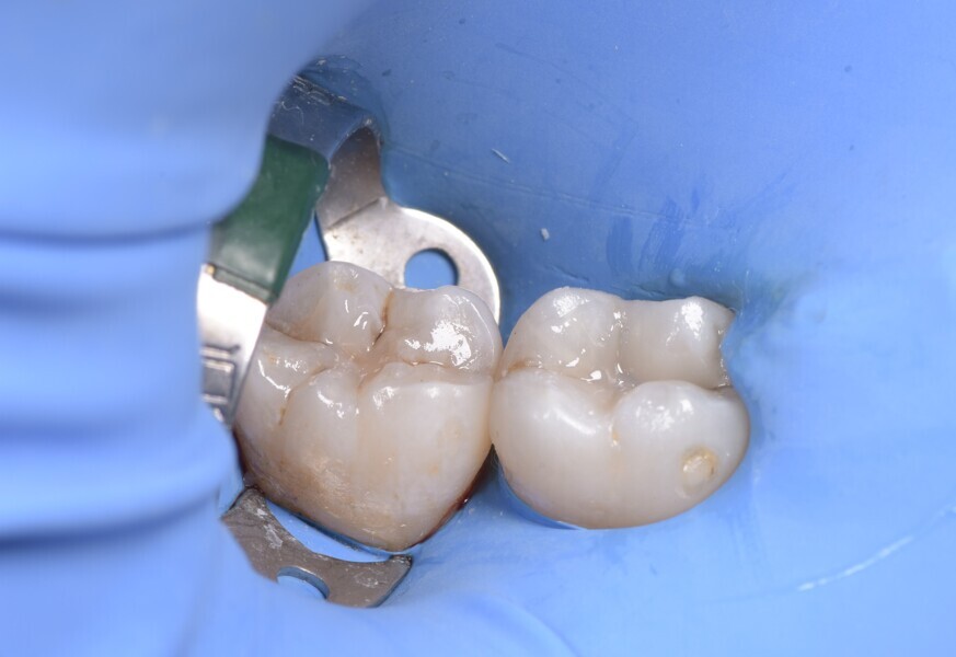 Fig. 6: Situation after completion of filling. 