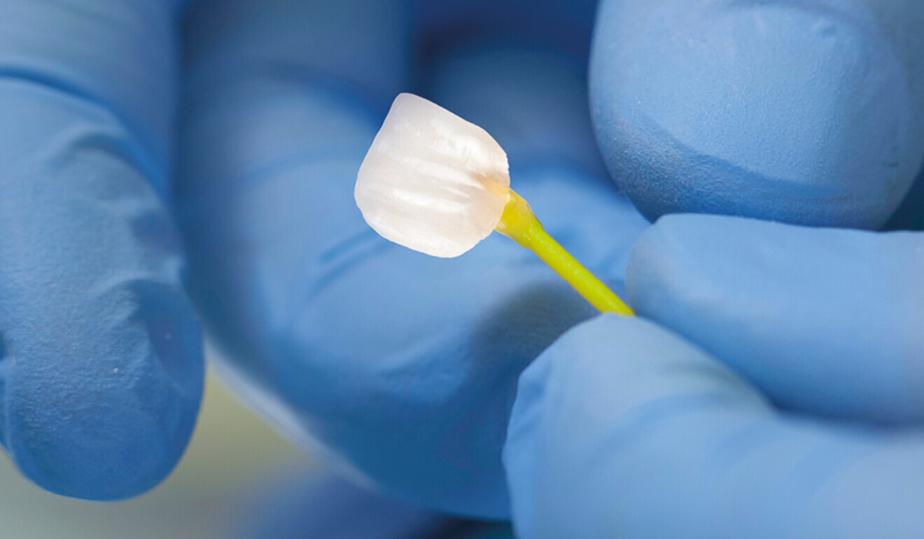 Handling of a thin ceramic veneer. (Image: Kuraray Noritake Dental)