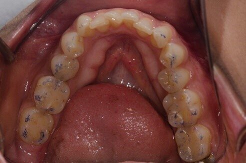 Fig 8: Occlusal equilibration carried out to harmonize contacts on all teeth from canine backwards and adjustments carried out in the end to keep the anterior restorations free from friction in the chewing cycle.