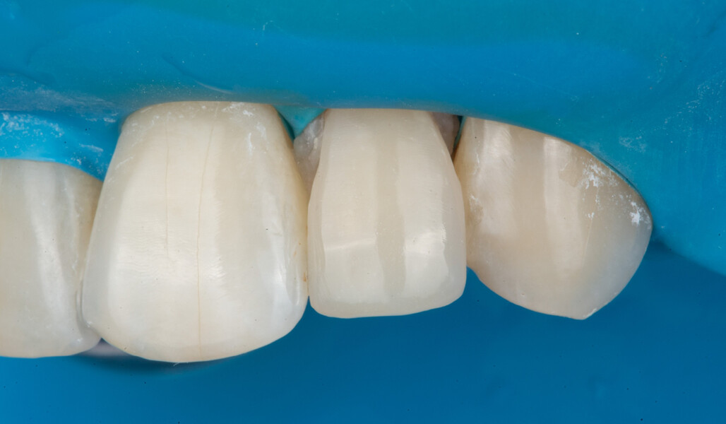 Fig. 6: Finished and polished surface of the restoration.