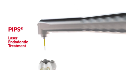 SWEEPS Photoacoustic Endodontics