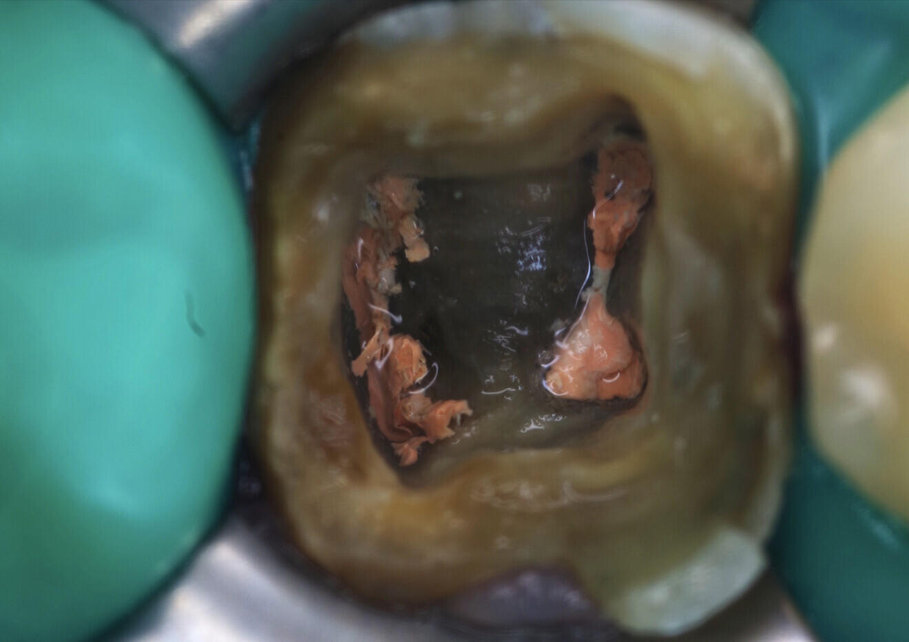 Fig. 4: Situation immediately after root canal filling. Gutta-percha needed to be cut properly. Poor condition of the residual dentine. No longer any enamel on the distal area.