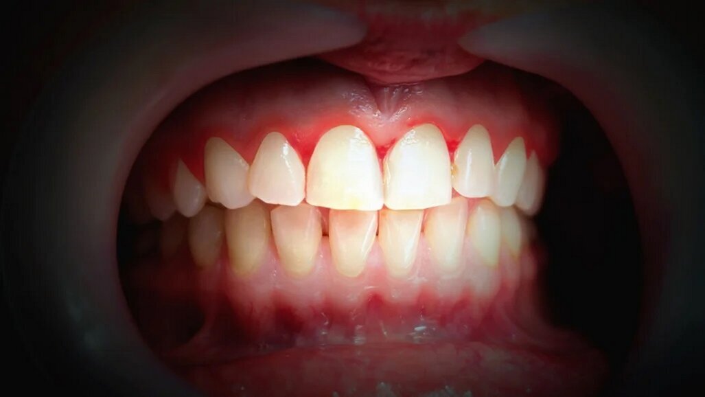 I přes dobrou ústní hygienu může lokální zánět dásní postihnout vzdálená zdravá místa v ústech