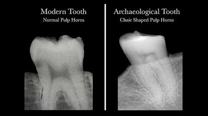 Scientists discover that dental radiographs can reveal vitamin D deficiency