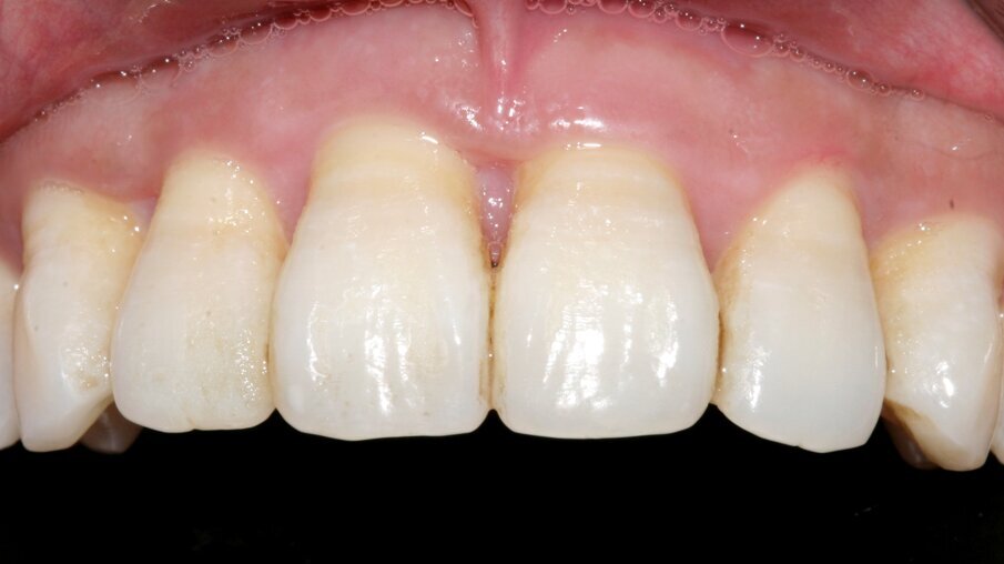 Fig. 4: 1 yr clinical photo demonstrating excellent periodontal health, with 2mm pocket depth, and increased zone of KG, with increased buccal bone support 