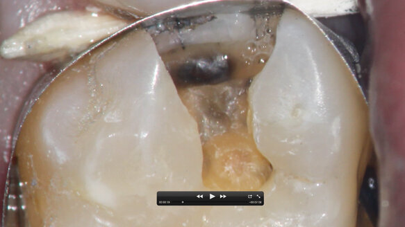 The dental microscope for general dentistry