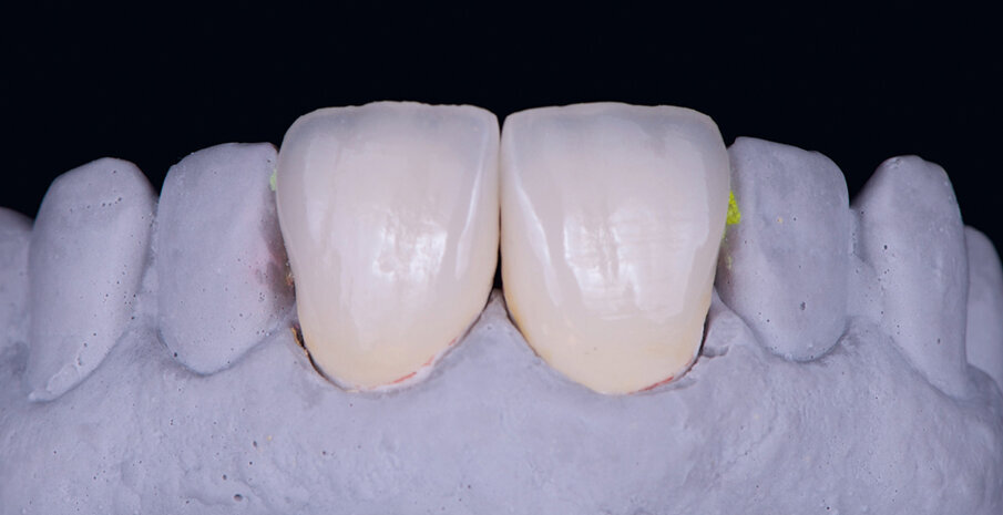 Fig. 10: The veneers with a high light dynamic on the model