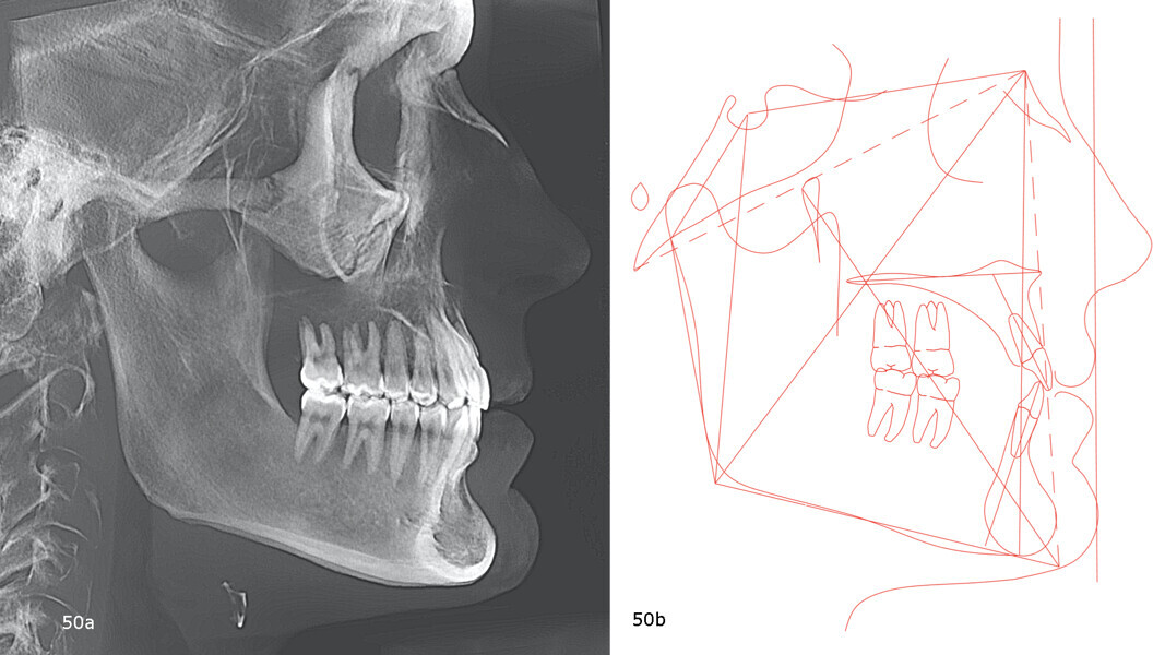 Figs. 50a & b: Post-treatment cephalometric radiograph (a) and tracing (b).