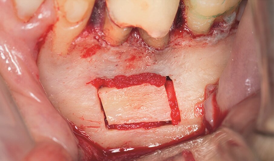 Fig. 1j: Finally, the cortical window was replaced and stabilised with collagen tape.