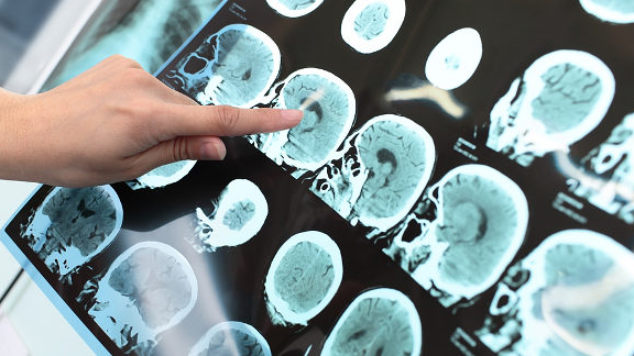 Slechte mondgezondheid leidt mogelijk tot alzheimer