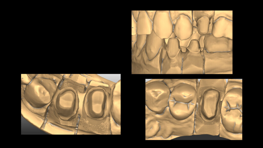 Fig. 6: Preparing the model for crowns #25, 34 and 35.