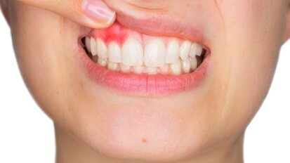 Cellen in gingiva bieden bescherming tegen parodontitis
