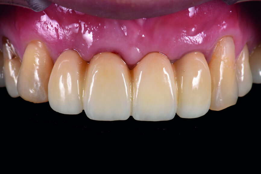 Fig. 43: Frontal view of the anterior teeth just after delivery.