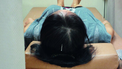 Acupuncture : Elle sonde le terrain en dentisterie – Partie I
