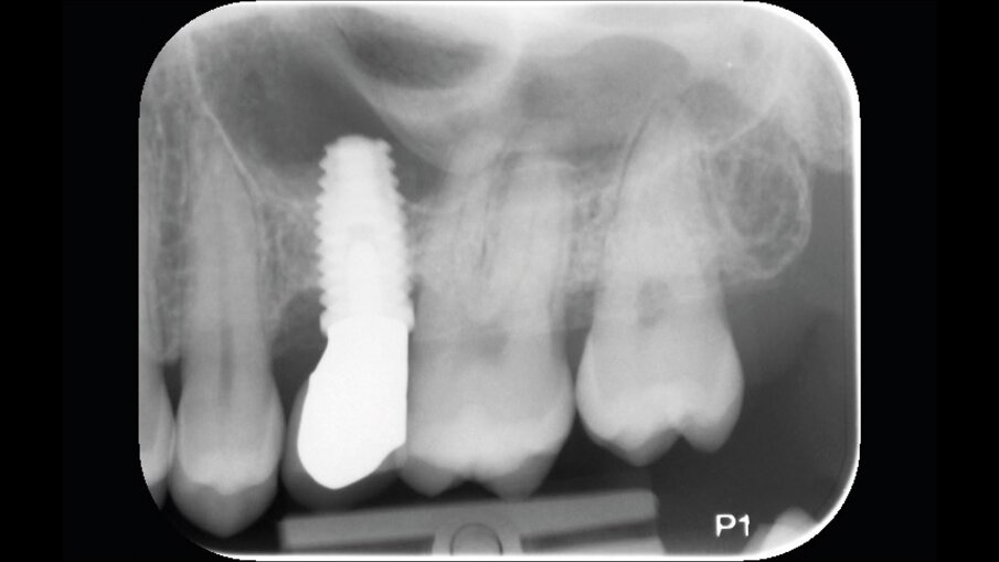 Fig. 3 - Radiografia endorale del sito 2.5 al baseline (impianto in sede 2.5 inserito nel 2017).