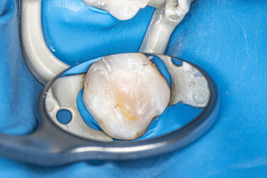 Fig. 28: The mandibular first molar with the temporary restoration before treatment.