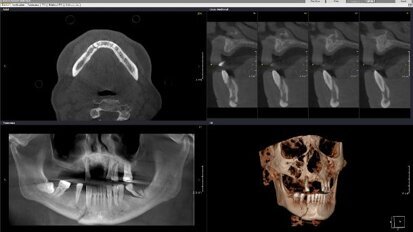 Webinar: Expert gives insights into CBCT-based diagnosis of trauma cases