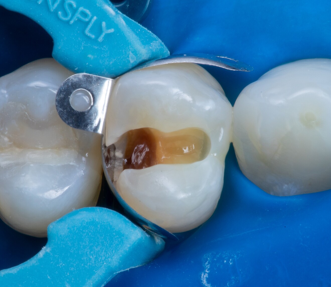 Fig. 1c: Matrix placement.
