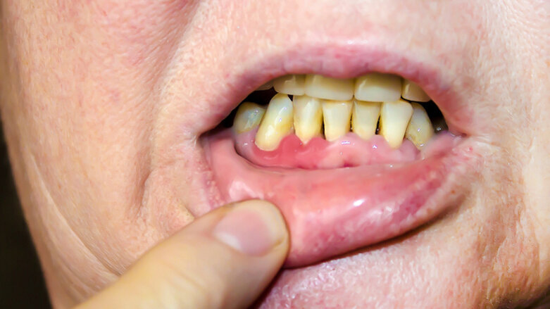 EFP and WHF release consensus report on links between periodontal and cardiovascular health