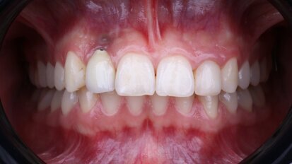 Effective strategies for managing late implant failure and peri-implantitis