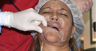 El rejuvenecimiento facial con ozono
