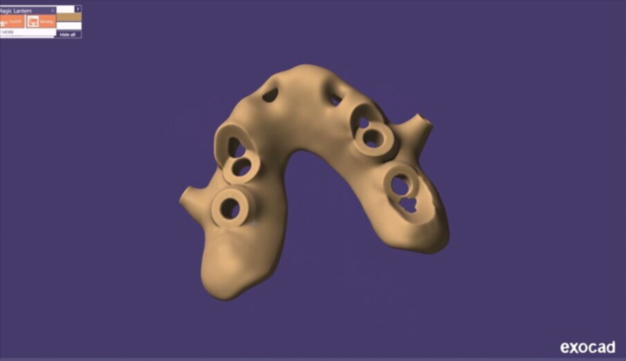 Figg. 26-28_Progettazione Cad con exocad.