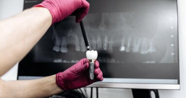 Treating complex implant cases: ITI webinar to cover treatment planning