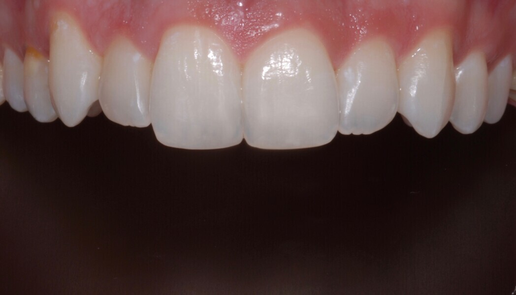 Fig. 26:  Intra-oral maxillary frontal view after treatment.