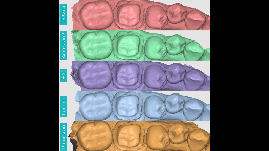 Fig. 5 - Scansioni in formato STL visualizzate in anteprima nell'applicazione Medit Design. TRIOS 5 (a). Aoralscan 3 (b). Medit i900 (c). ITero Lumina (d). CEREC Primescan (e). 