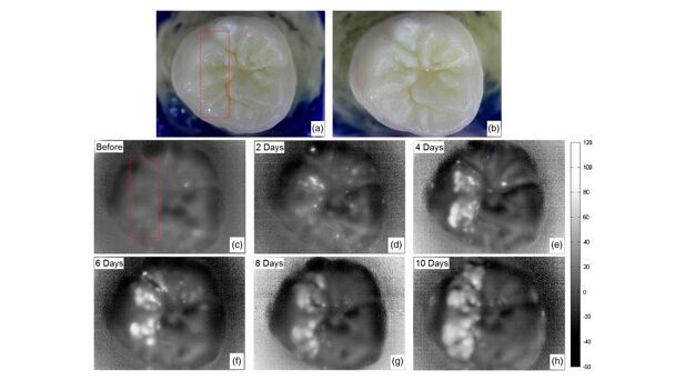 Un nuovo dispositivo di imaging potrebbe facilitare l’individuazione delle carie