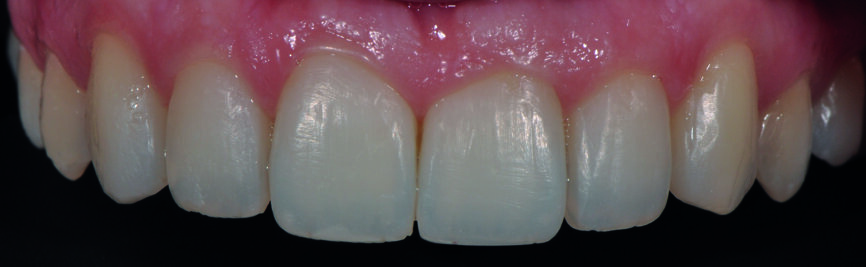 Fig 6 c) : vue intraorale de face. La teinte du composite est bien intégrée, quelle que soit la direction d’où l’on regarde, indépendamment de la lumière incidente