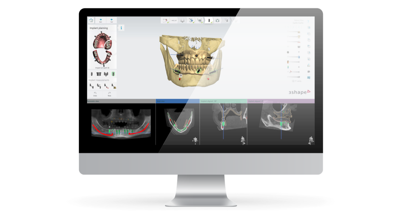 AI can assist in the design of surgical guides for implant placement. (Image: 3Shape)