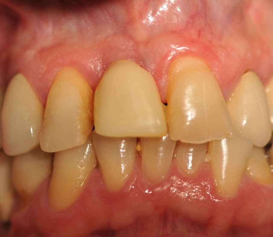 Fig. 4_Situazione clinica con corona provvisoria a 3 mesi.