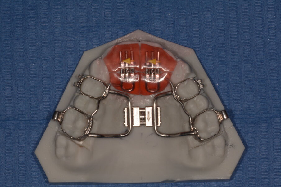 Figg. 2a-2c - Esempio di modello di lavoro ortodontico ottenuto da file .stl.