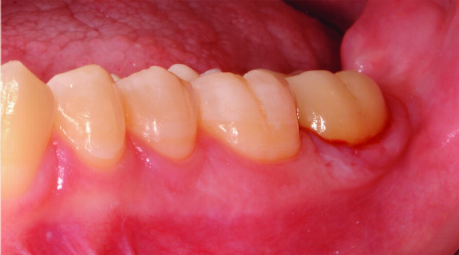 Fig. 15: Immediate final clinical situation.