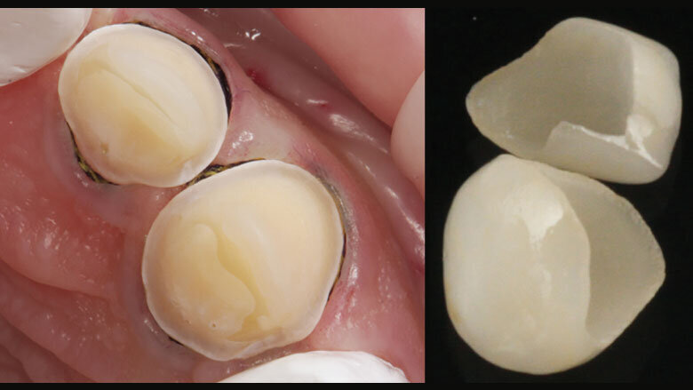 Figure 12: Adhesive cementation of the restorations in the upper anterior jaw