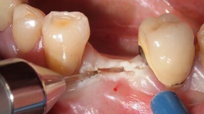 Valutazioni preliminari di inserti in Zaffiro e laser a diodi 915nm in chirurgia implantare