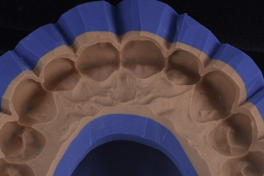 Fig. 33: Silicone index for the mock-up in double material.