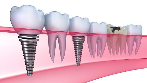 Implantaten weer vergoed door VGZ