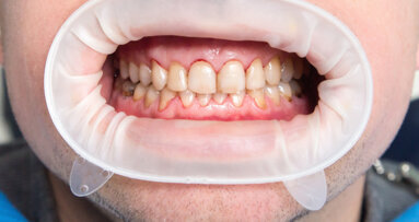 New study offers mechanistic view of dental fluorosis occurrence