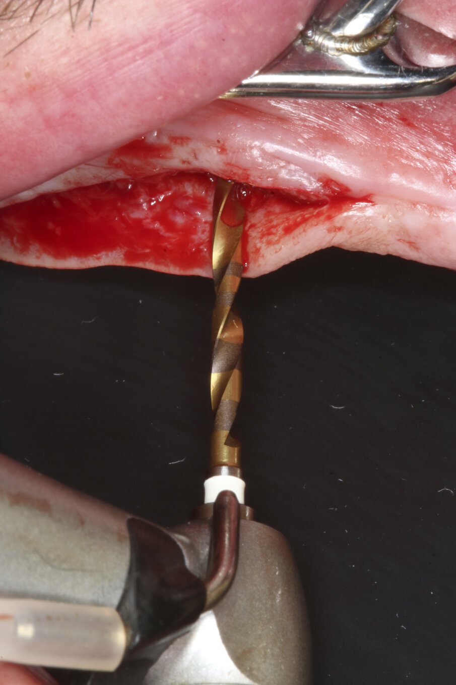 Fig. 5a–c: Implant bed preparation following the recommended drilling protocol for the planned implant using drill #1 (5a)...