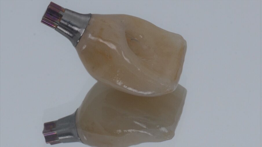 Fig. 30_Corona monolitica in ceramica cementata su abutment Variobase.