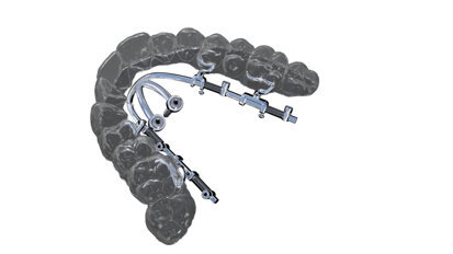 Mini-implant-borne sliders and expanders to overcome aligner limitations