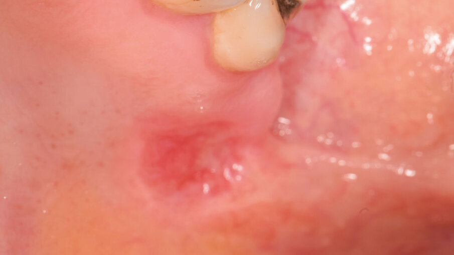 Fig. 4 - Guarigione a meno di una settimana.
